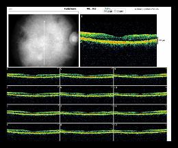 RADIAL LINE OD